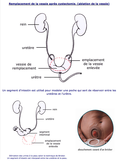 Ablation de la vessie