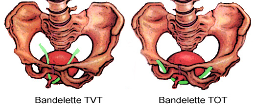 Incontinence